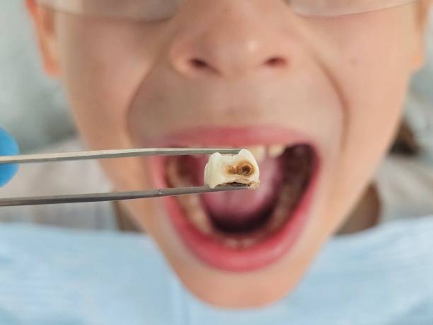 Best Emergency Tooth Extraction in Flemington, GA